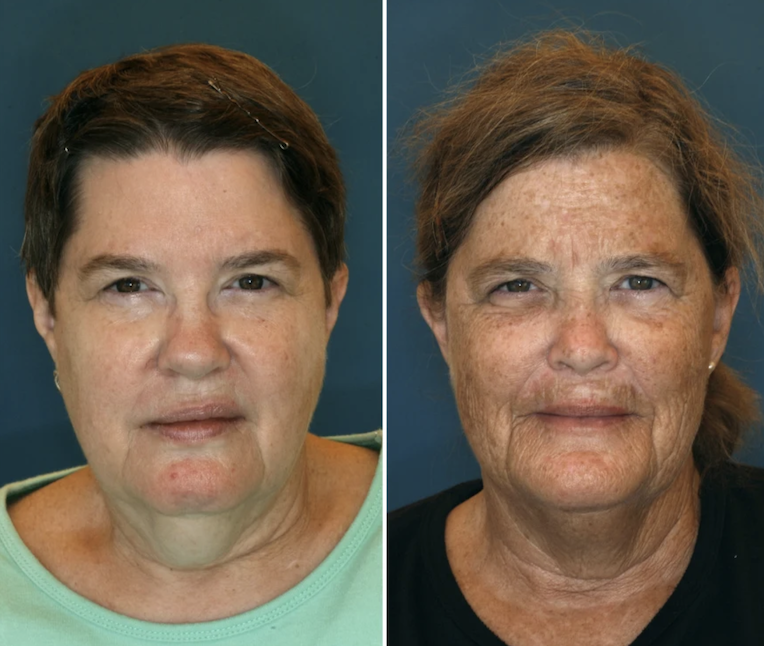 Premature Ageing Case Study in Twins